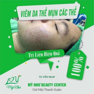 CÁCH NHẬN BIẾT VÀ DIỄN TIẾN VIÊN DA CORTICOID