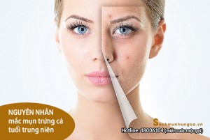 THỦ PHẠM G Y MỤN TUỔI Ở TUỔI TRUNG NIÊN