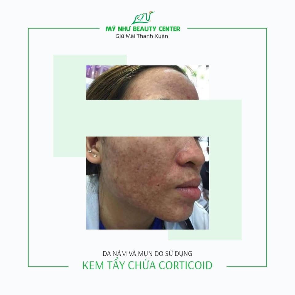 Nám Da Nhiễm Độc Corticoid và MELASMA